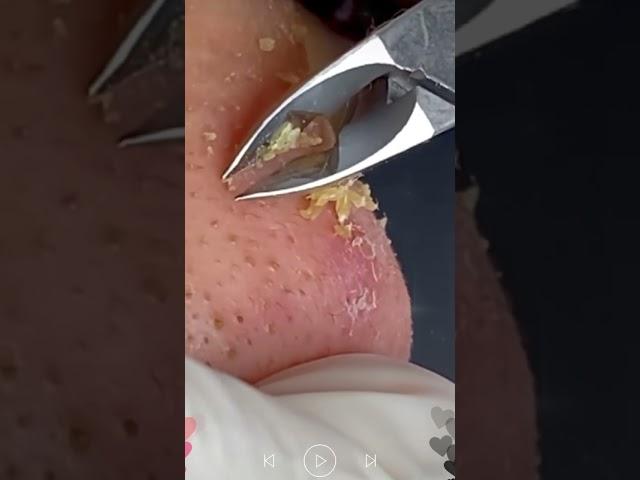 Skincare | Blackheads Removal #485 #tweezers skincare #blackheads blackheads