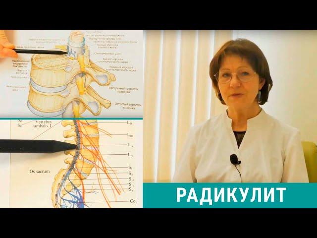 Радикулит: симптомы и лечение радикулита