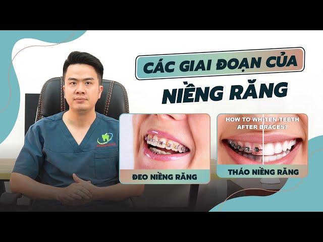 NIỀNG RĂNG SẼ PHẢI TRẢI QUA CÁC GIAI ĐOẠN NÀO?