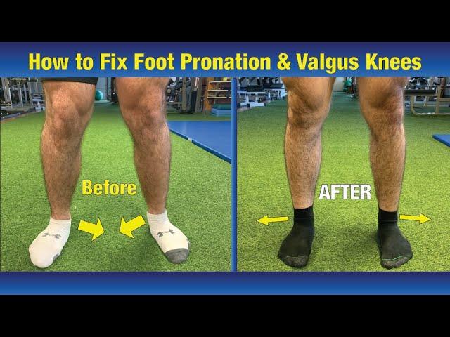 VERY EFFECTIVE Way to FIX Pronated feet & Knees Caving In (Valgus Knees)