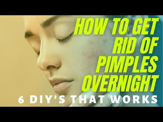 How To Get Rid Of Pimples OVERNIGHT: 6 DIY’s That Work! 2021