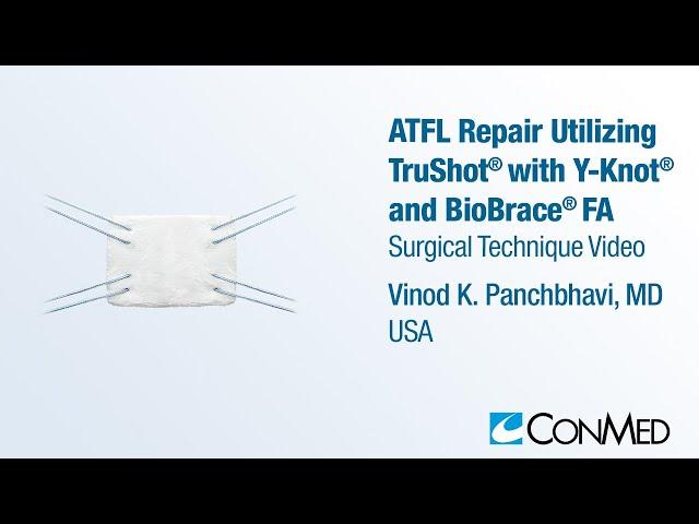 Dr. Vinod Panchbhavi - ATFL Repair Utilizing TruShot® with Y-Knot® and BioBrace® - CONMED Technique