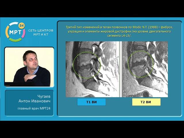 МРТ диагностика дегенеративно-дистрофических заболеваний позвоночника