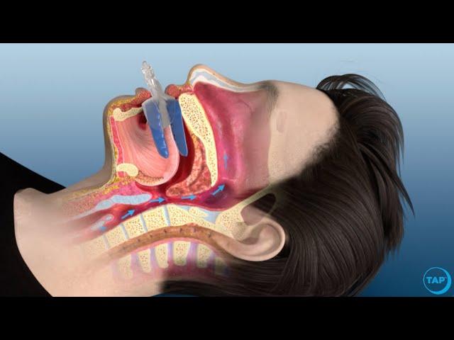 flexTAP Oral Appliance for Sleep Apnea: How Does It Work?