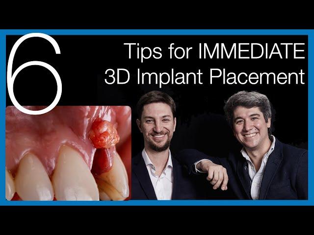  [Immediate Dental Implant Placement] 6 Tips for Success - Implantology Talks