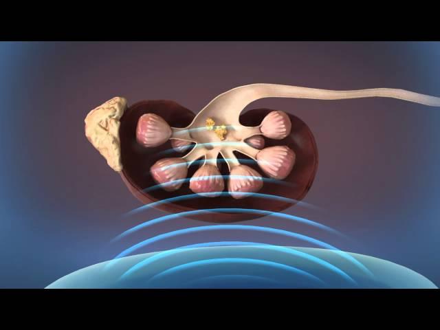 Shockwave Lithotripsy (SWL)