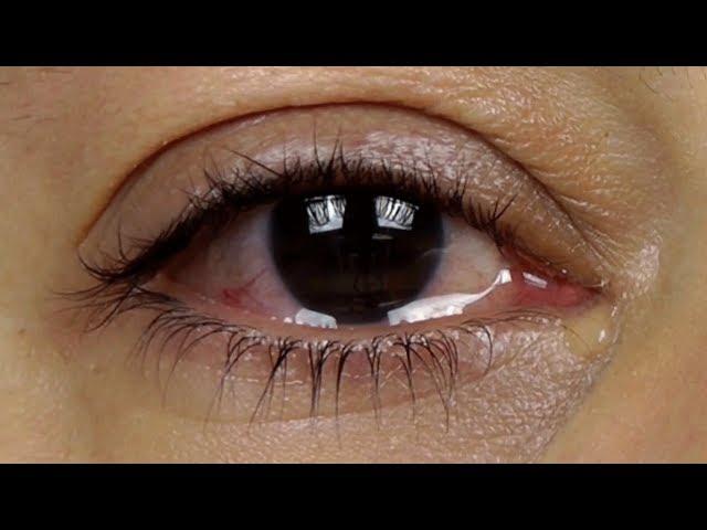 How to stop watery eyes? - Dr. Sunita Rana Agarwal