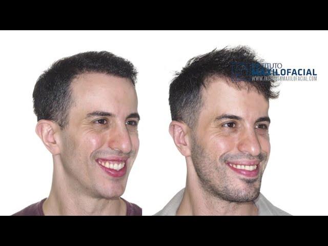 Double jaw surgery Case # 82: Daniel- Biretrusion, long face