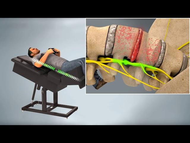 Des Moines Spinal Decompression Traction by Back on Trac at Compass Chiropractic