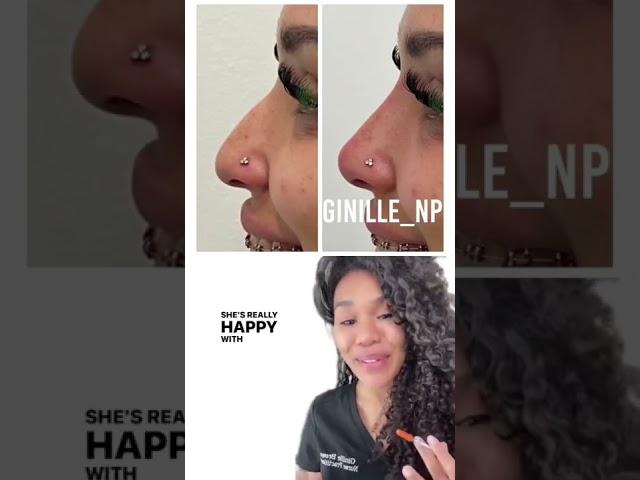 #nonsurgicalrhinoplasty #blackgirlnosejob #nosefiller #ginillenp Filler Injector Ginille