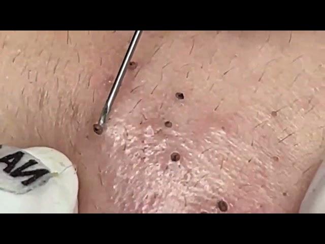 blackheads acne treatment blackheads new 2023 today blackheads new this week