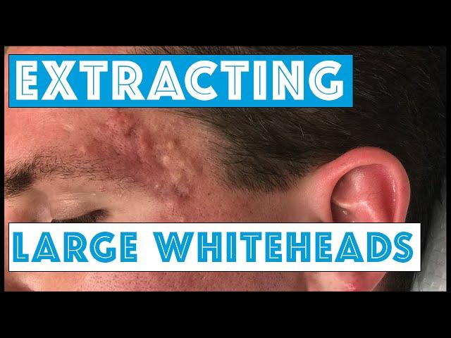 Acne Vulgaris and Extracting large Whiteheads - Part 1