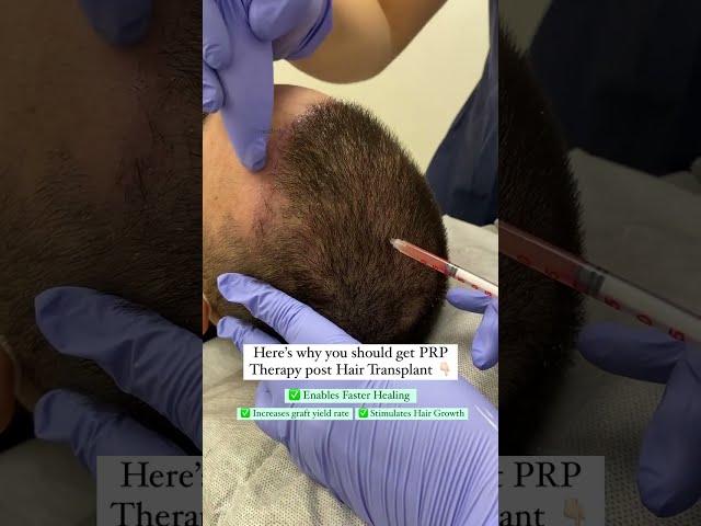 {2024) PRP Treatment | Post Hair Transplant Technique #shorts #shortsfeed Medlinks