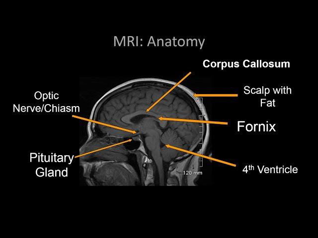 Normal Brain MRI Anatomy - Neuroradiology Made simple