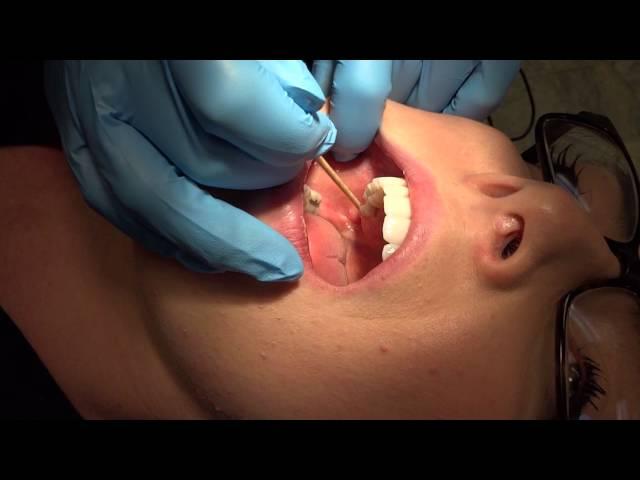 Inferior Alveolar Injection