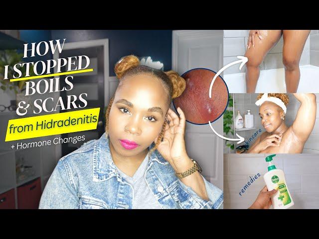 How I STOPPED HS Boils in Underarms and Thighs | Hormone Changes, Diet, Hygiene etc.