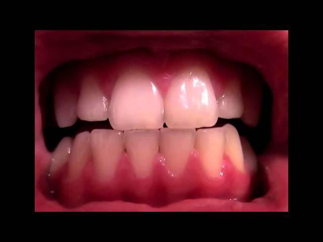 Review: Crest 3D White Strips Professional Effects - Before & After Pictures
