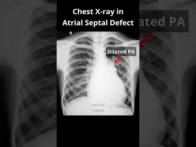 Chest Xray (Part 2) in Atrial septal defect (ASD) #shorts #asd #cxr