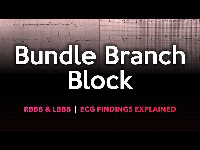 Left and Right Bundle Branch Block: ECG Made Easy