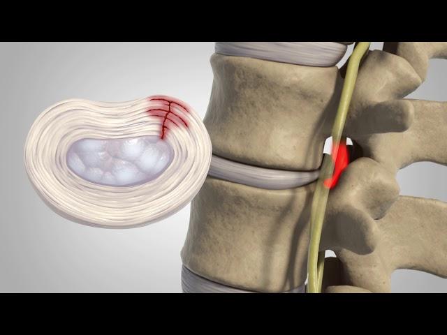 Herniated Disc - Patient Education