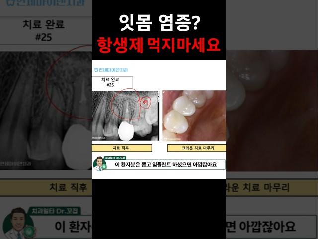 잇몸 염증? 항생제 먹지마세요. 신경치료 3년 후 증례