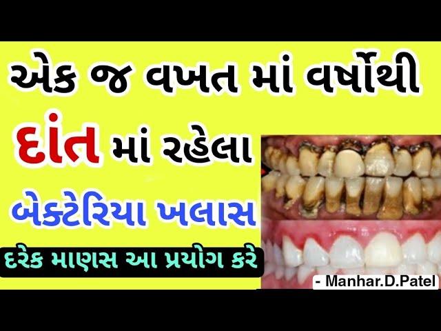 એક જ વખત માં વર્ષોથી દાંત માં રહેલા બેક્ટેરિયા ખલાસ || Manhar.D.Patel