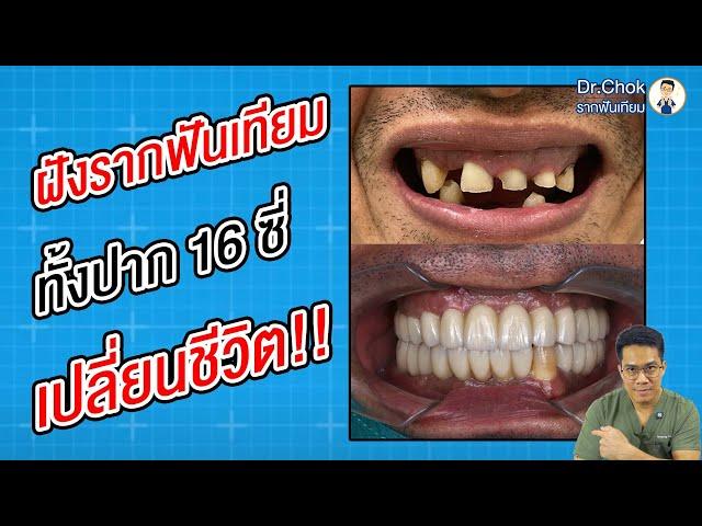 ฝังรากฟันเทียม ทั้งปาก 16 ซี่ เปลี่ยนชีวิต!! ทำโดย ทพ.ธนพงษ์ (หมอหนึ่ง) | คลายปัญหาฟันกับทีมหมอโชค