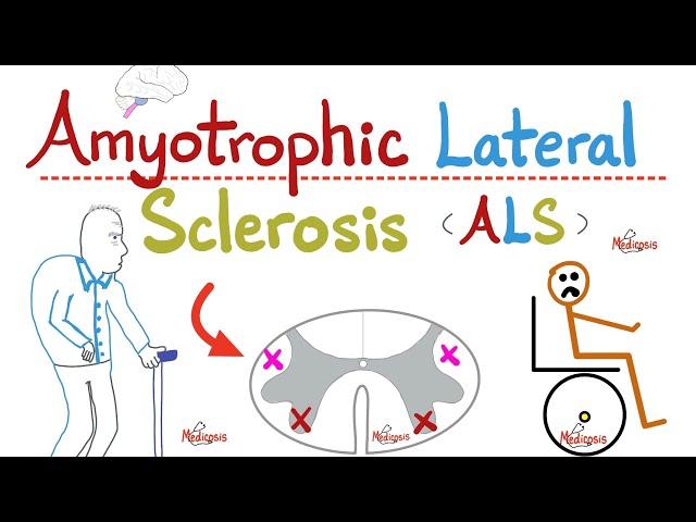 Amyotrophic Lateral Sclerosis (ALS) -  Lou Gherig disease - UMNL & LMNL - Paralysis - Neurology