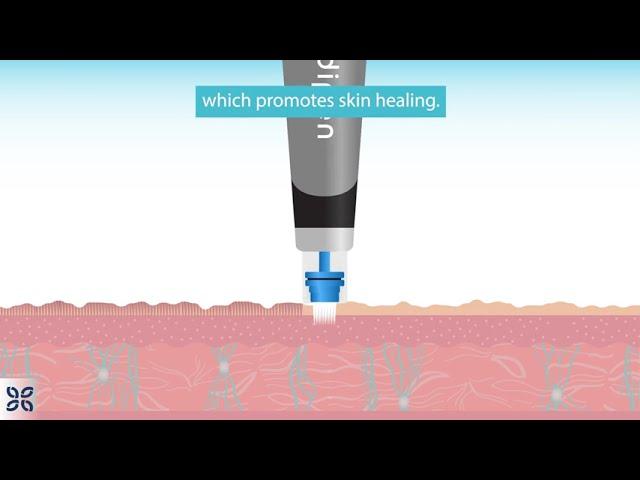 Micro-Needling Explained: Animation