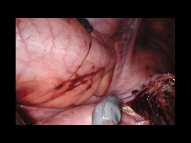 Robotic Myomectomy of a 600 g Fibroid