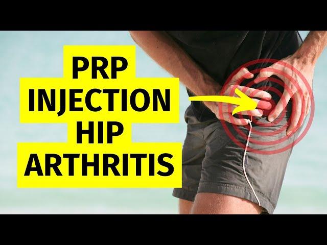 Platelet Rich Plasma (PRP) Injections for Hip Arthritis