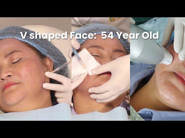 V shaped Face treatments on a 54-Year Old female