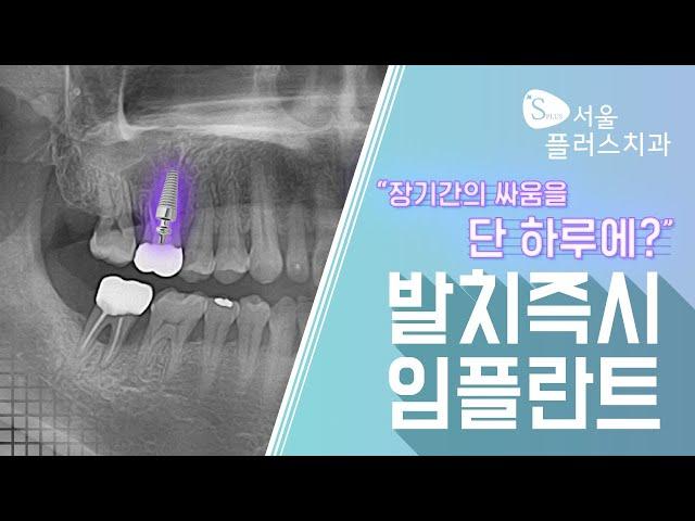 이제는 발치 즉시 임플란트가 대세 [성남서울플러스치과]