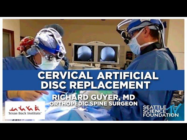 Cervical Artificial Disk Replacement - Richard Guyer, M.D.