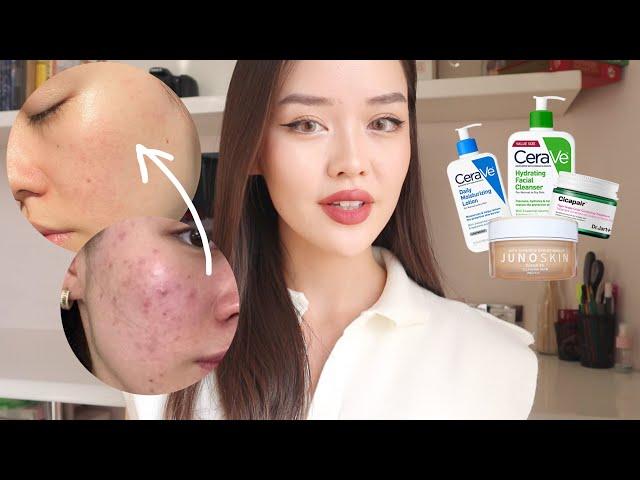 HOW I GOT RID OF MY ACNE + unsponsored skincare routine 