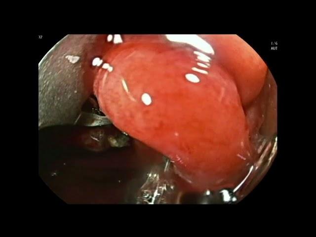 EFTR of large ectopic pancreas in stomach with wound closure using OverStitch