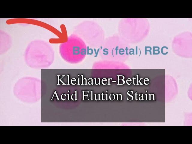 Kleihauer-Betke Stain to detect Fetal-Maternal Hemorrhage