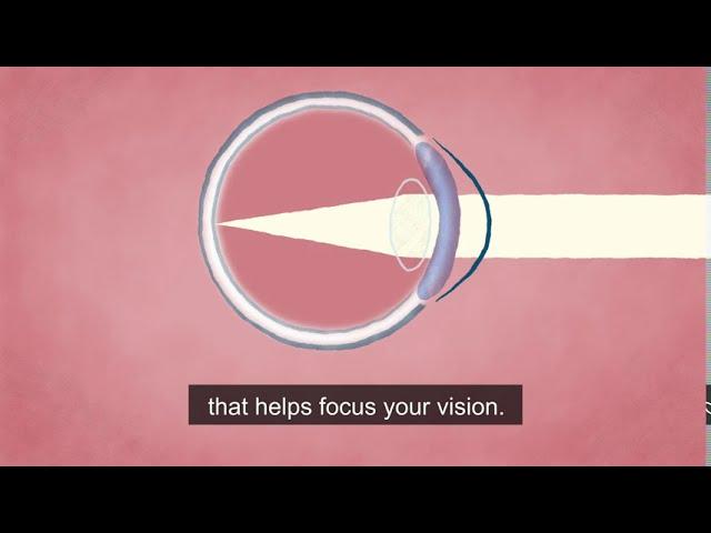 A Cutting-Edge Treatment for Cornea Damage