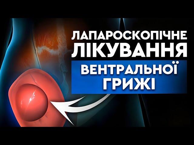 Лапароскопічне лікування вентральної кили