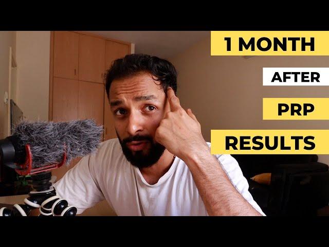 PRP Results after 1 month, Does PRP for hair loss actually work?