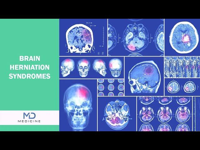 Brain Under Pressure: Recognizing the Signs of Brain Herniation Syndromes - @mdmedicine.network