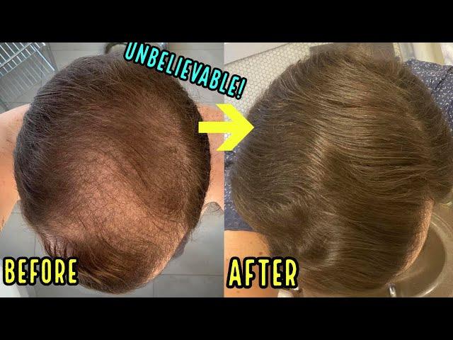 HE REGREW HIS BALD HEAD USING THESE 3 SIMPLE HAIR LOSS TREATMENTS!