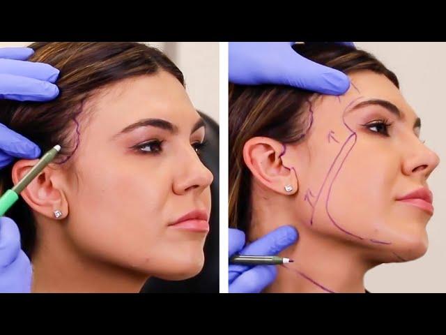 Where are the facial incisions for a facelift? Incisions for Vertical Restore™ Facelift