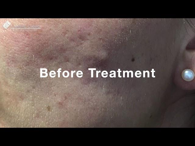 Emergency Spot Treatment | Lumiere Clinic Manchester | Skin & Aesthetics