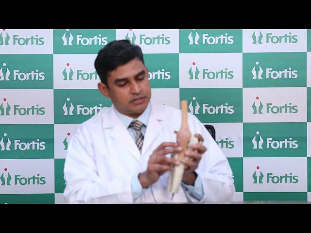 Knee Arthritis, Dr Vinay Kumaraswamy | Fortis Hospital, Rajajinagar