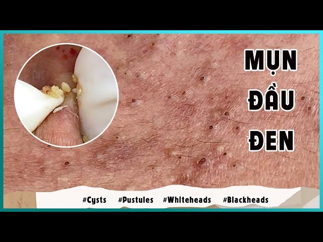 Big Cystic Acne Blackheads Extraction Blackheads & Milia, Whiteheads Removal Pimple Popping