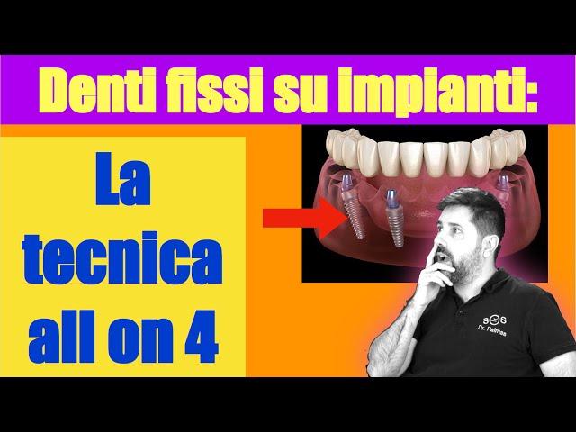 La guida definitiva: Denti fissi su 4 impianti ( all on four )