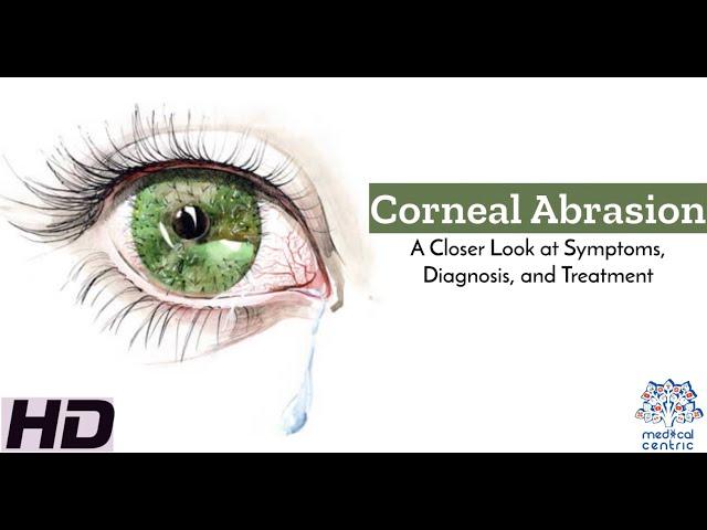 Corneal Abrasion: A Closer Look