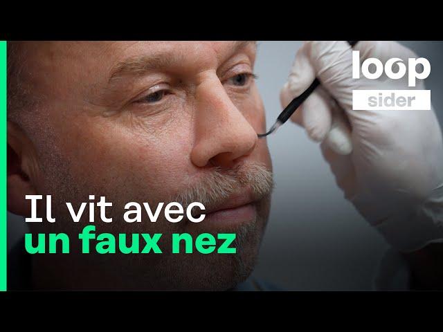 « Je ne pensais pas qu'on pouvait avoir un cancer du nez », Michel raconte sa vie sans nez