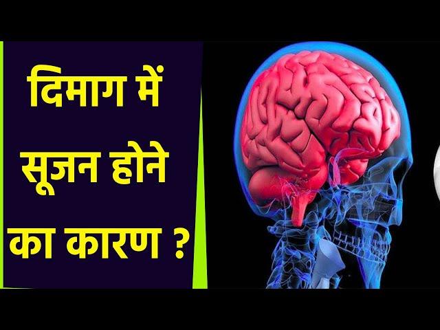 दिमाग में सूजन क्यों हो जाती है। दिमाग में सूजन होने का कारण। दिमाग में सूजन होने का इलाज। Boldsky